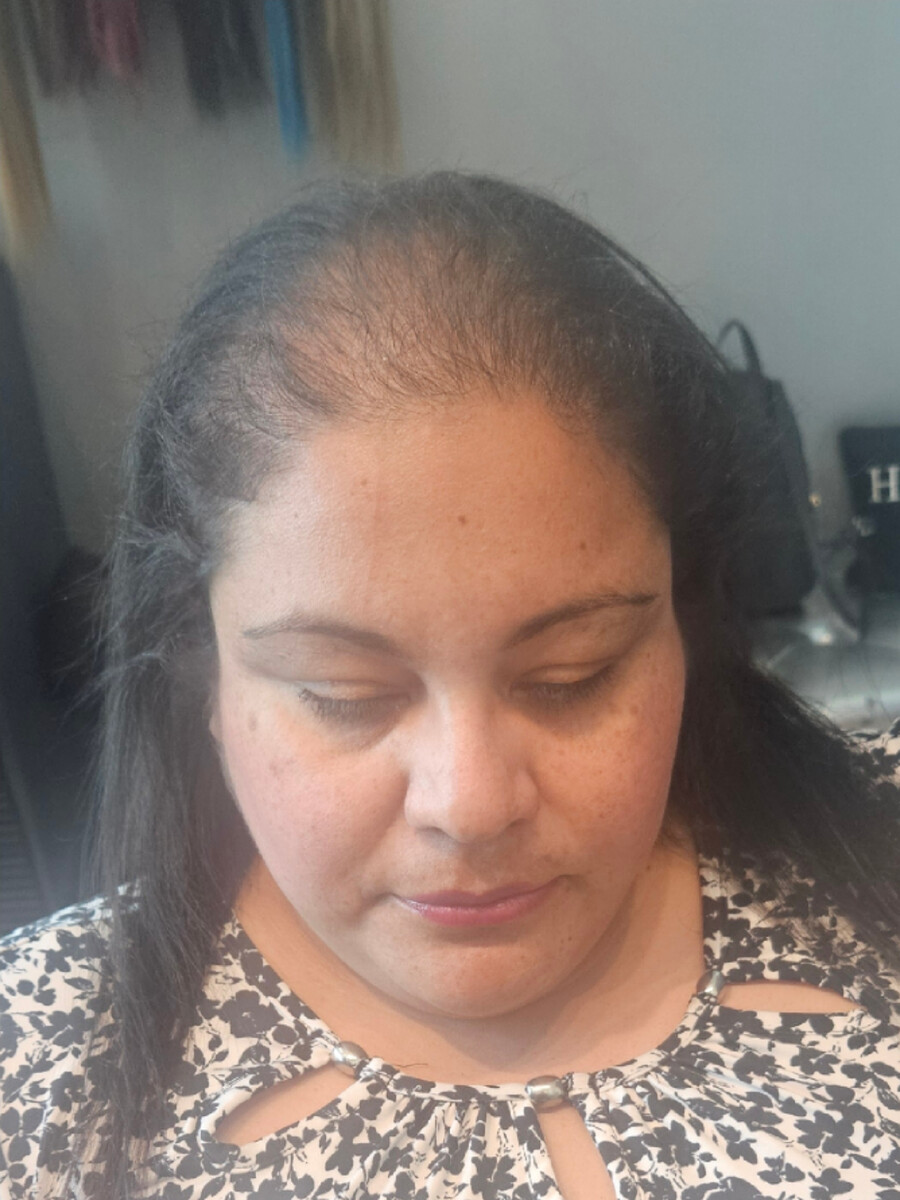 Thin, flat dark hair, sparse at the crown, before